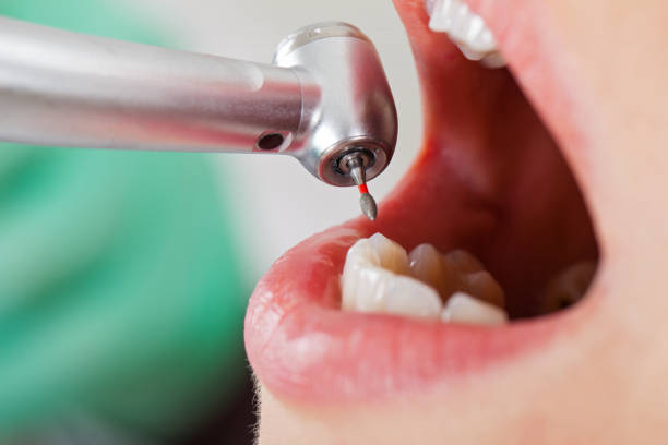 Best Emergency Treatment for Oral Infections in Abernathy, TX